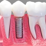 مواد و تجهیزات پروتز دندانپزشکی